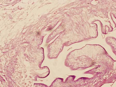 Figure 1: Photomicrograph showing cysticercosis